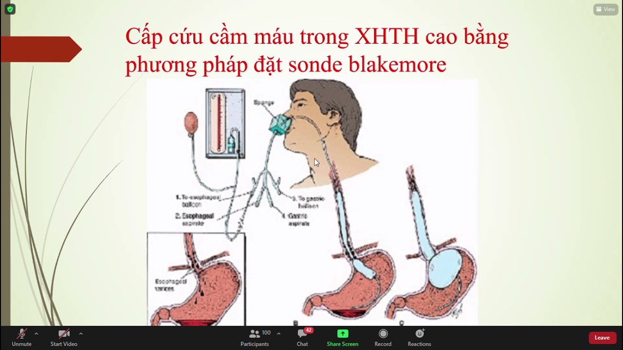 Kỹ thuật đặt Aline đo IBP - kỹ thuật đo CVP. 52p. Hồi... - youtube