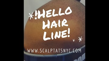 Scalp micro pigmentation  New York (NYC)(2019).60 is the new 40.