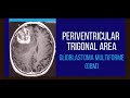 Periventricular Trigonal Area | Glioblastoma Multforme | Dr. Sukhdeep Singh Jhawar