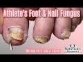 👣Reverse Nail Fungus Caused by Athlete's Feet👣