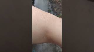 Download Lagu muscle, tendon,,,,? something tore loose.... MP3