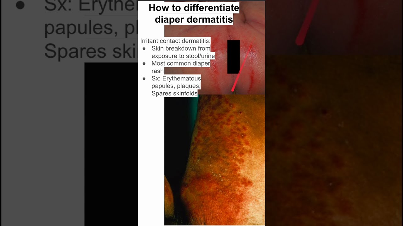 How To Differentiate Diaper Dermatitis