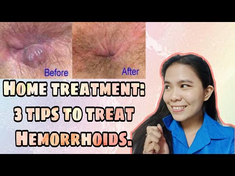 3 TIPS TO CURE HEMORRHOIDS OR "ALMORANAS" / HOME TREATMENT(2020) / Philippines / Angeleca Gelacio