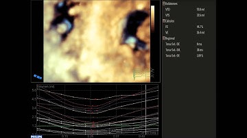 QLAB 10.1  Echocardiography 3D and Strain 2D
