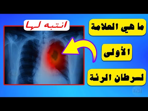 اعراض سرطان الرئة في المرحلة الاولى