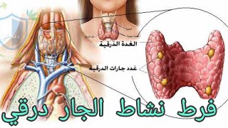 فرط نشاط جارات الدرقية وتأثيرها على الغدة الدرقية