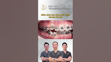 Răng khấp khểnh trở nên đều đặn nhờ Niềng Răng Mắc Cài