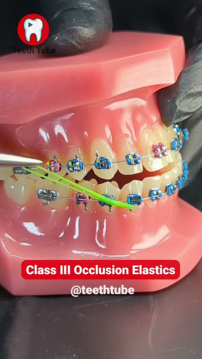 Class III Occlusion Elastics #shorts