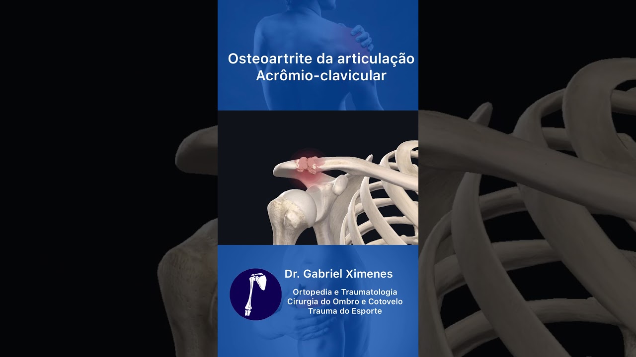 ARTROSE ACRÔMIOCLAVICULAR CIRURGIA DE MUMFORD POR ARTROSCOPIA (RESSECÇÃO LATERAL DA CLAVÍCULA ARTROSE ACRÔMIOCLAVICULAR CIRURGIA DE MUMFORD POR ARTROSCOPIA (RESSECÇÃO LATERAL DA CLAVÍCULA