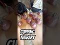 Cupping Therapy for Back Tension Relief