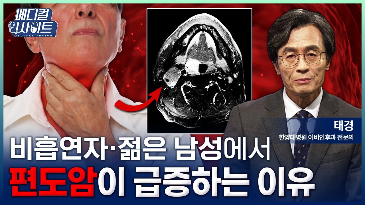 [메디컬 인사이트 159회] 편도염과 착각하기 쉬운 '편도암'의 증상과 치료법 / YTN