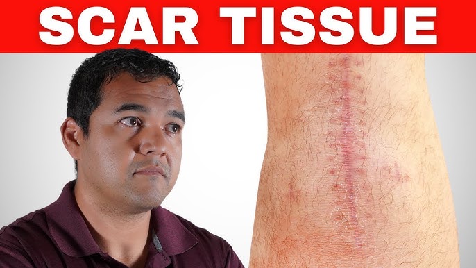 Understanding Scar Tissue 