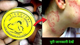 दाद का आखरी इलाज | Ringozone Ointment Uses Or Side Effects in hindi