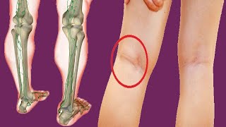Swollen Popliteal Lymph Nodes Behind Knee: Causes And Treatment