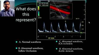 Secrets of Carotid Ultrasound