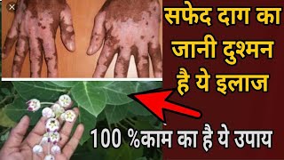 सफेद दाग का इलाज/सफेद दाग का जानी दुश्मन/Leucoderma Vitiligo Treatment at home 100%safed dag ka ilaj