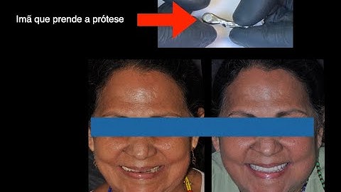 Overdenture retida por um clipe e dois magnetos