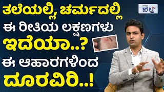 ಸ್ಕಾಲ್ಪ್ ಸೋರಿಯಾಸಿಸ್‌ಗೆ ಶಾಶ್ವತ ಪರಿಹಾರ ತಿಳಿಯಿರಿ..! |Scalp Psoriasis Treatment And Symptoms | Hair Care