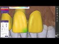 #exocad temporary crovn virual grinding.Millbox CAM Software Installation | Dental Milling Setup