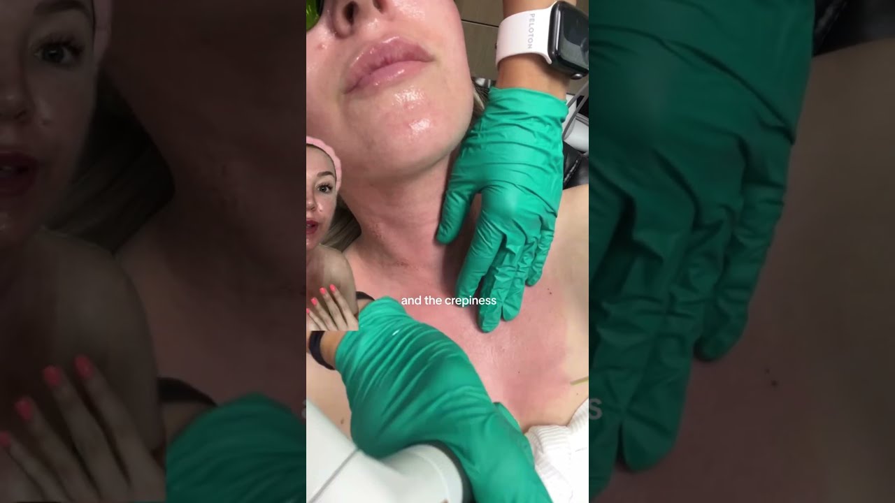 Fotona 4D Non Ablative Laser Treatment 