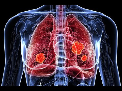 Video: Immunberikning Av Icke-småcellig Lungcancer Baslinebiopsier För Multiplexprofilering Definierar Prognostiska Immunkontrollpunkter För Patientens Stratifiering