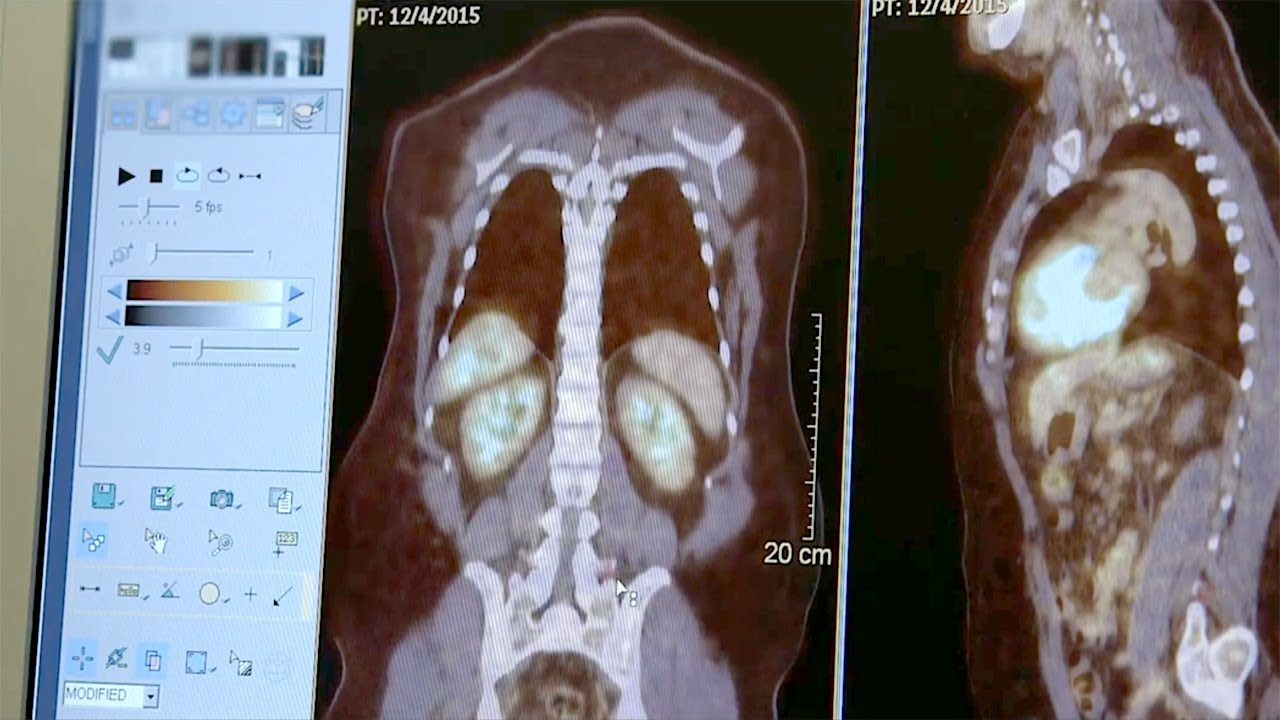 Lung Cancer The Risks Of Lung Cancer Lung Cancer The Risks Of Lung Cancer