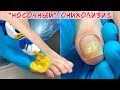 Онихолизис ногтей / Как выбрать носки по размеру