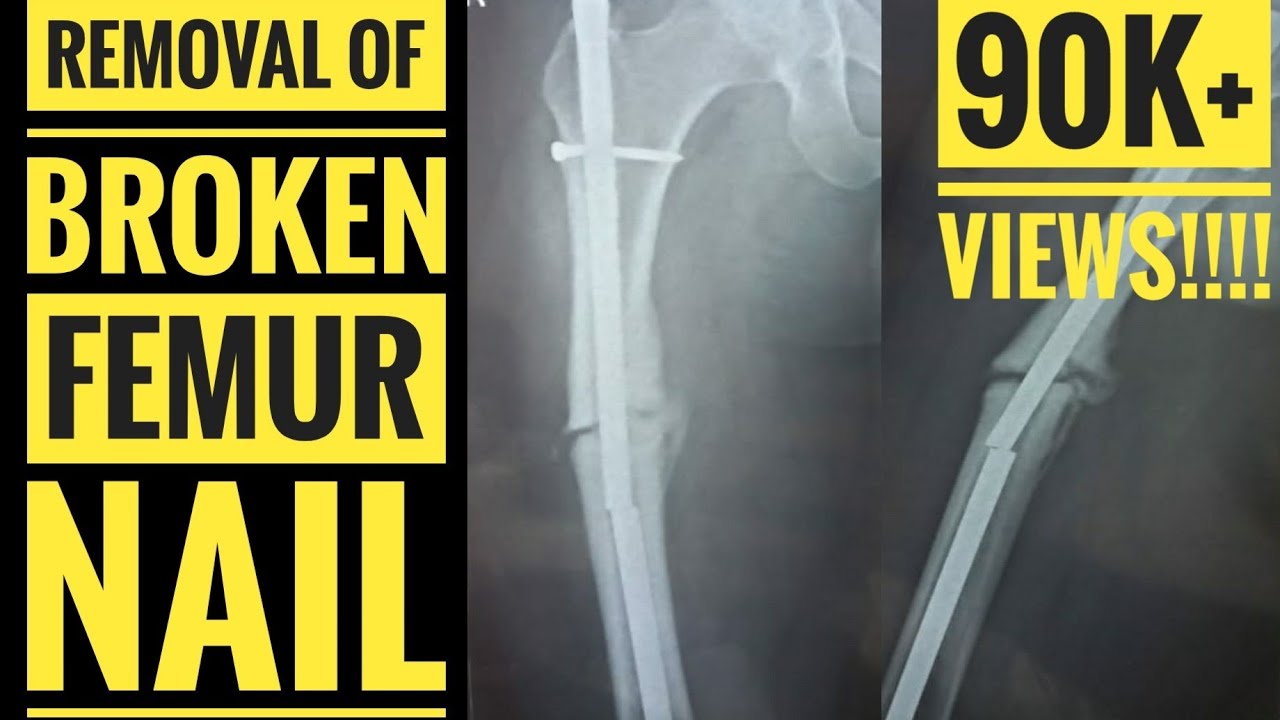 Femoral Shaft Fractures