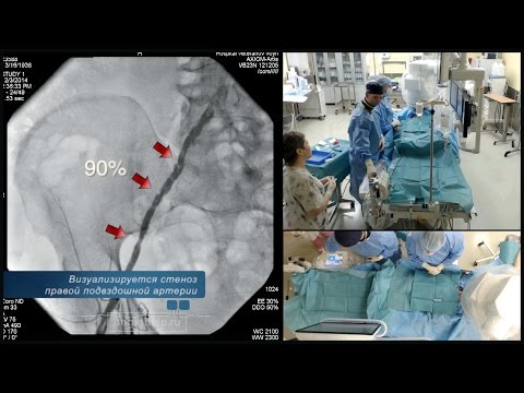Video: Angioplasti Arteri Periferal Dan Penempatan Stent
