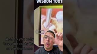 Different Ways Wisdom Teeth Are Extracted | In Office to Hands On Dental Training