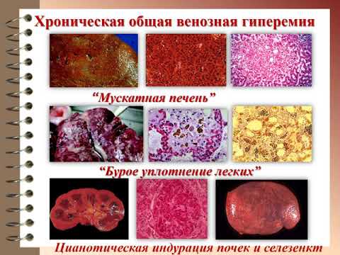 Патология - Лекция - Нарушения кровообращения