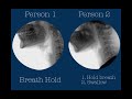 Swallowing postures and maneuvers withfluoroscopy two healthy adults