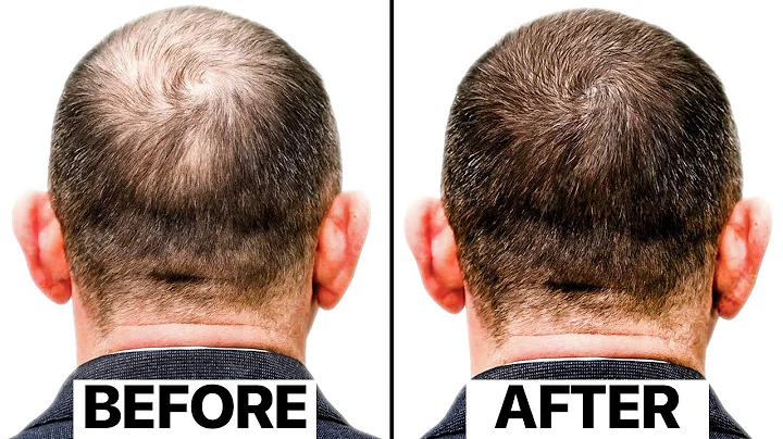 The Truth Behind This New Hair Loss Treatment | Exosomes - DayDayNews