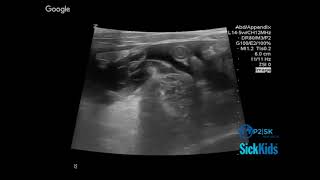 Appendicitis (4/6)