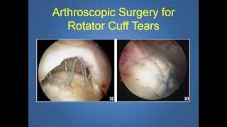 Rotator cuff Tears explained by a Phoenix Orthopedic Surgeon (480) 219-3342