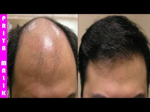 वीडियो: 100% प्राकृतिक बालों के झड़ने के उपचार को कैसे प्राप्त करें?