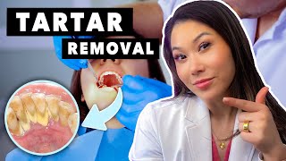 What is Tartar and How to Remove it