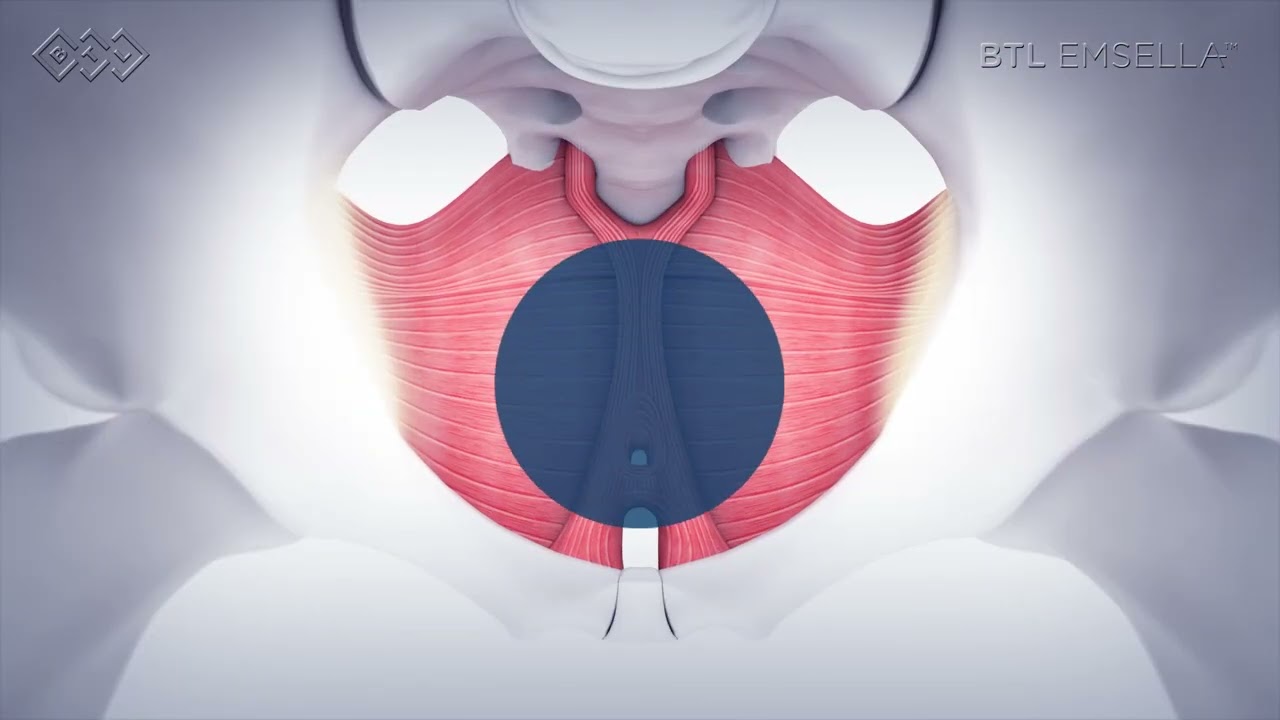 BTL Emsella VIDEO