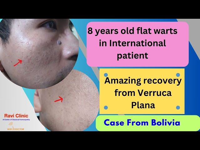 Amazing recovery from 8 years old flat warts in an International patient