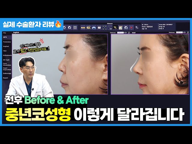 중년 코 성형 진짜 변할까?🤔 실제 사례로 보는 중년 코 성형 결과!! / 망설이기만 했던 분들 꼭 보세요!