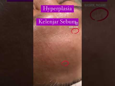 Video: Di mana kelenjar sebum?