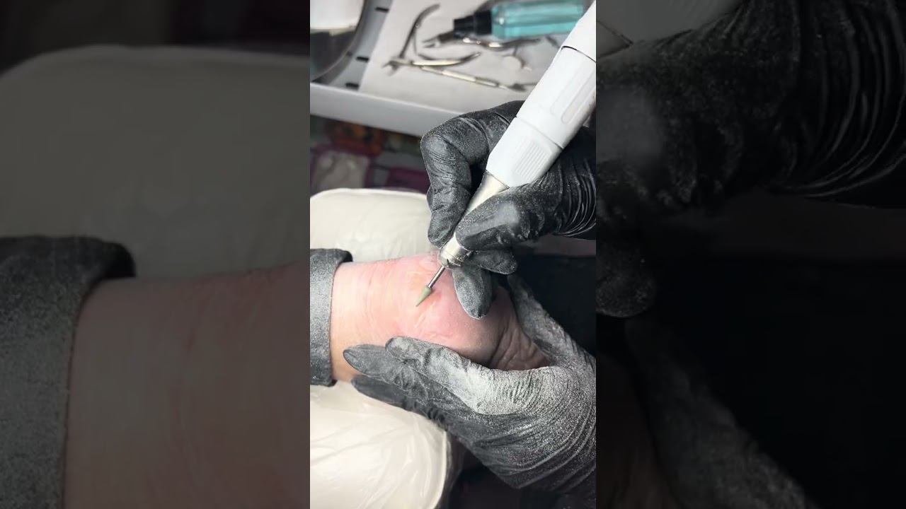 Pedicure # hard skin removal #deadskinremoval #healthyfeet #crackedheelcare #pedicuretransformation 