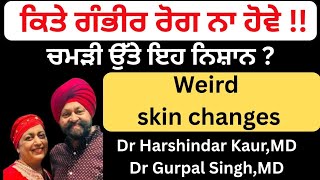 ⁣837  - Weird skin changes! ਚਮੜੀ ਉੱਪਰਲੇ ਨਿਸ਼ਾਨ ! ਕਿਤੇ ਗੰਭੀਰ ਰੋਗ ਨਾ ਹੋਵੇ !!!