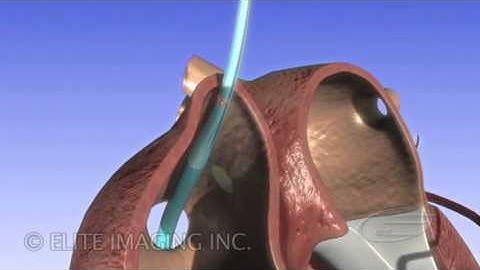 Expandable Transseptal Introducer - Medical & Scientific Video Production