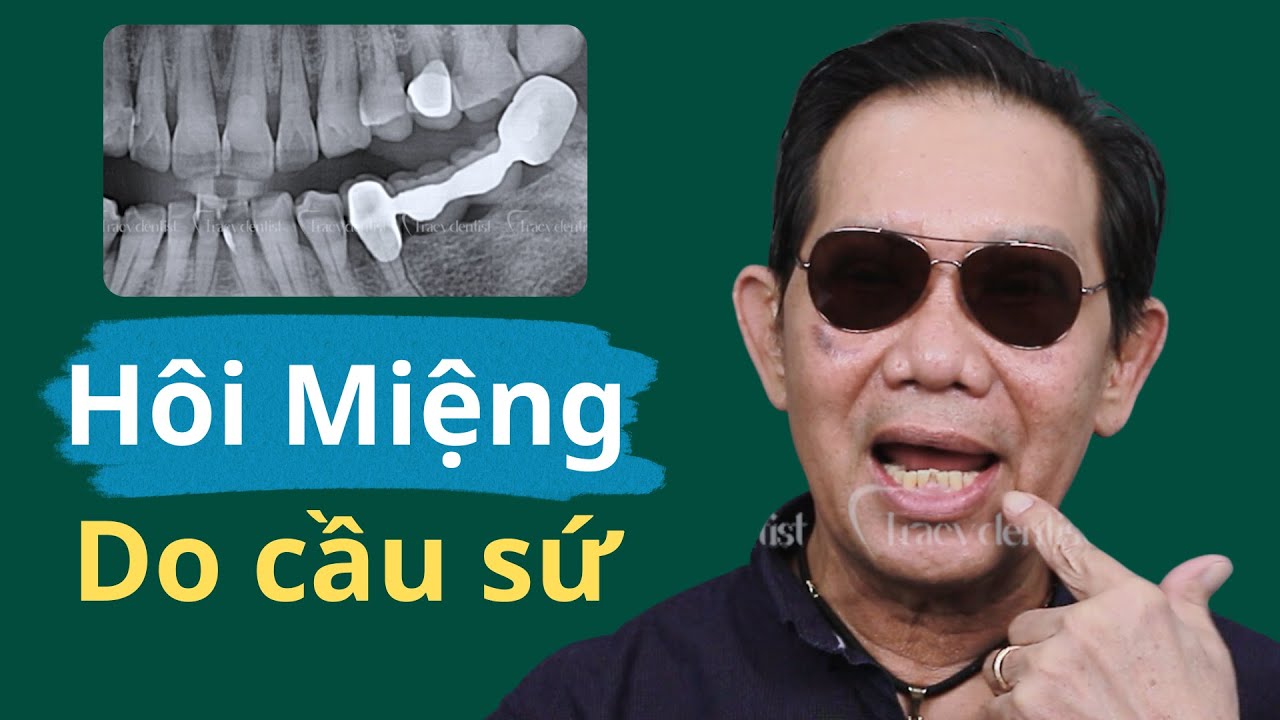 Outline Video Cầu răng sứ bị hở nguyên nhân dẫn đến hôi miệng của chú Tôi - Nước Úc | Tracy Dentist