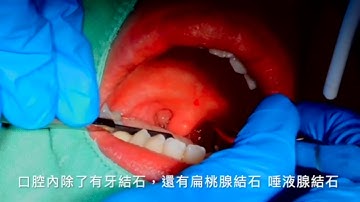 扁桃腺結石