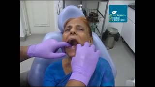 Complete Dentures: Border Molding and Final Impression Technique demo.