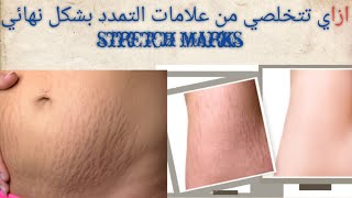 أسرع وافضل علاج و وصفات تمدد الجلد بشكل نهائي stretch marks