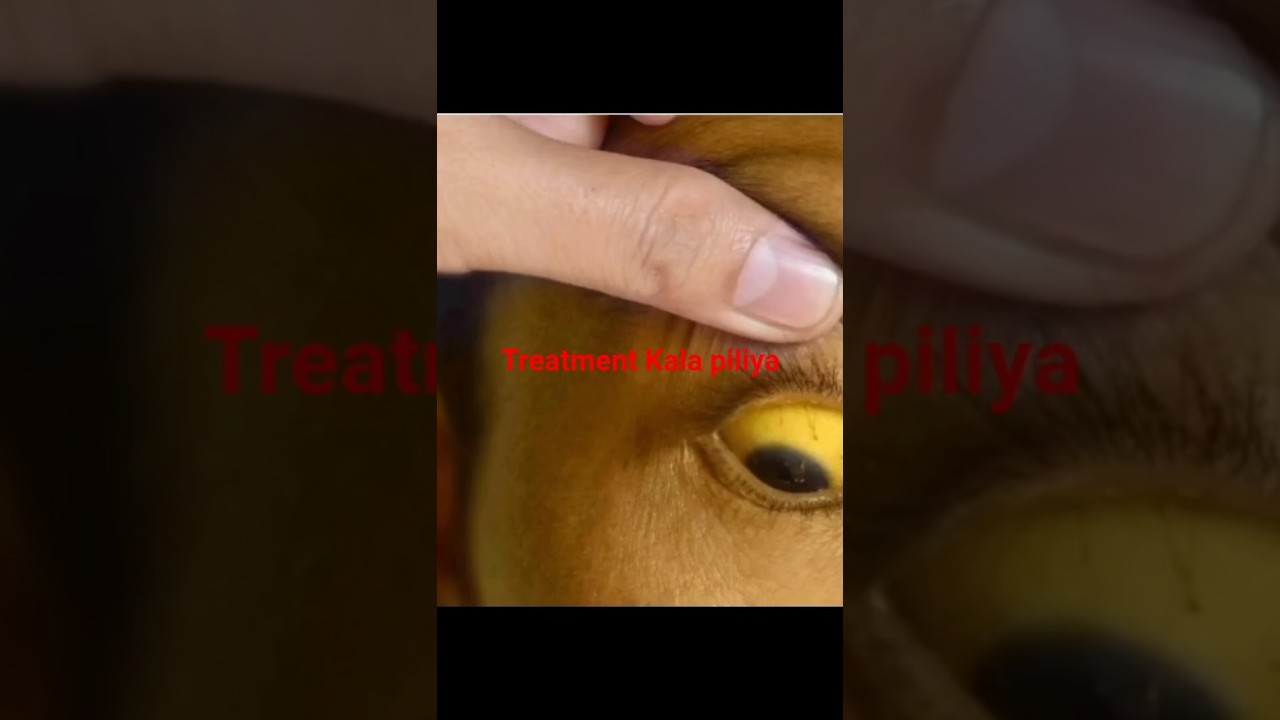 treatment Kala piliya