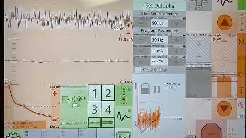 Dr. Georgios Matis - Neuromodulation - Spinal cord stimulation - Closed loop therapy